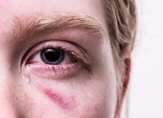 Jakim kolorem zakryć siniaka?